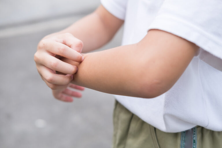 How to Stop An Autistic Child from Scratching Heartlinks